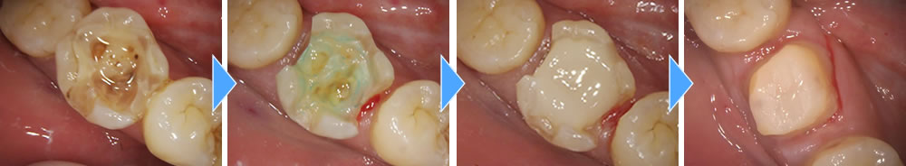 虫歯治療の実施